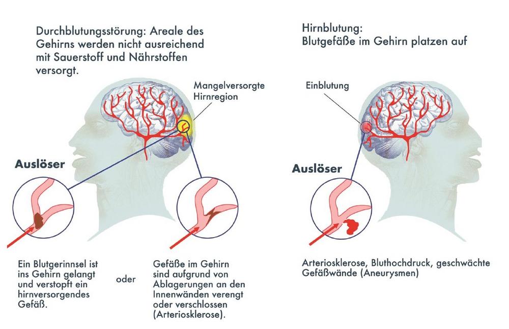 Schlaganfall: Jeder fünfte bleibt rätselhaft