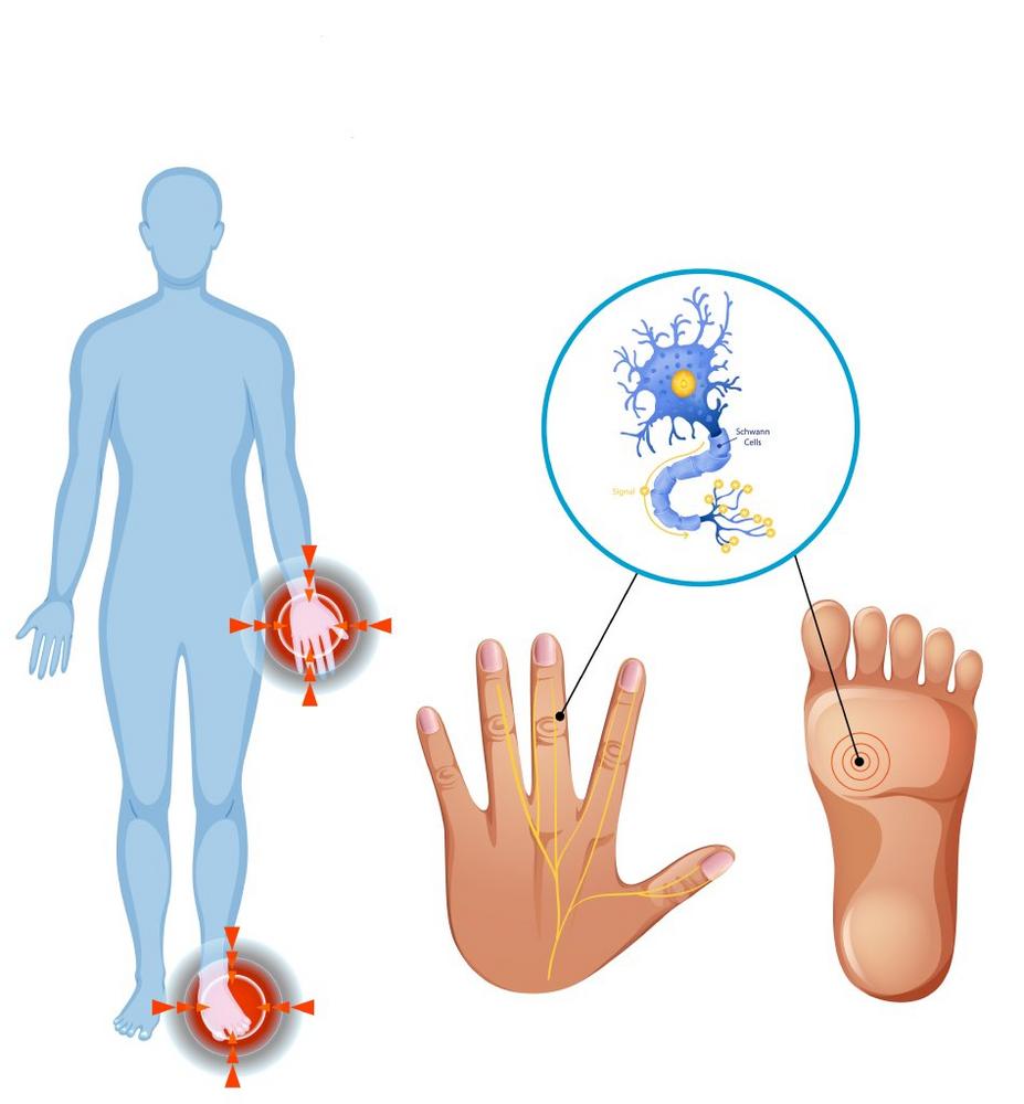 Polyneuropathie – Glarustherapie diagnostiziert Ursachen und behandelt die Nervenkrankheit