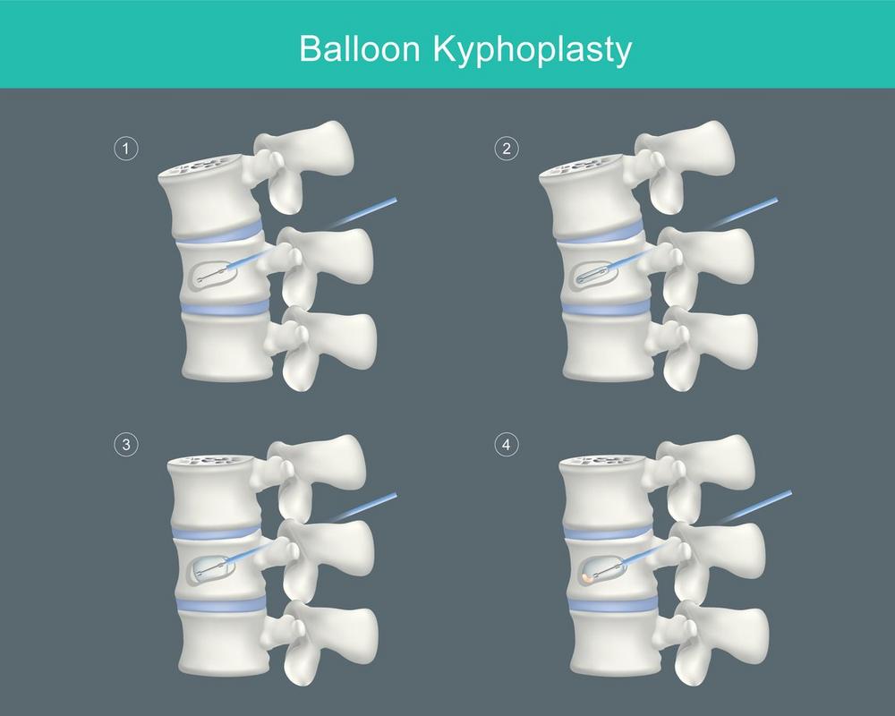 Osteoporose & Wirbelkörperbruch