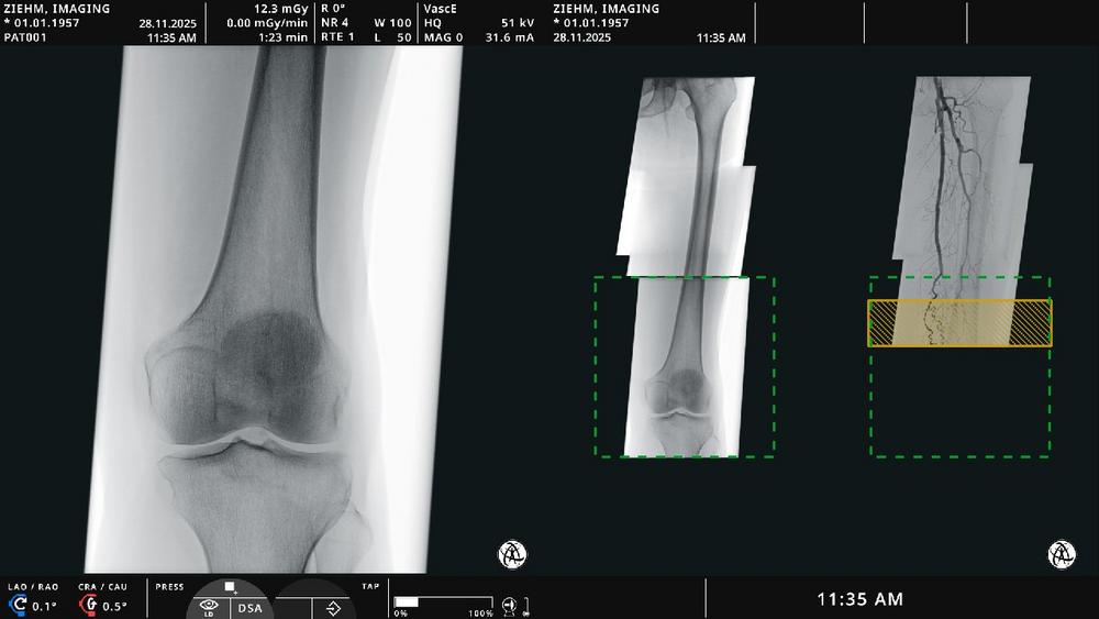 ECR 2026: Ziehm Imaging showcases new OR table steering and latest endovascular software solution