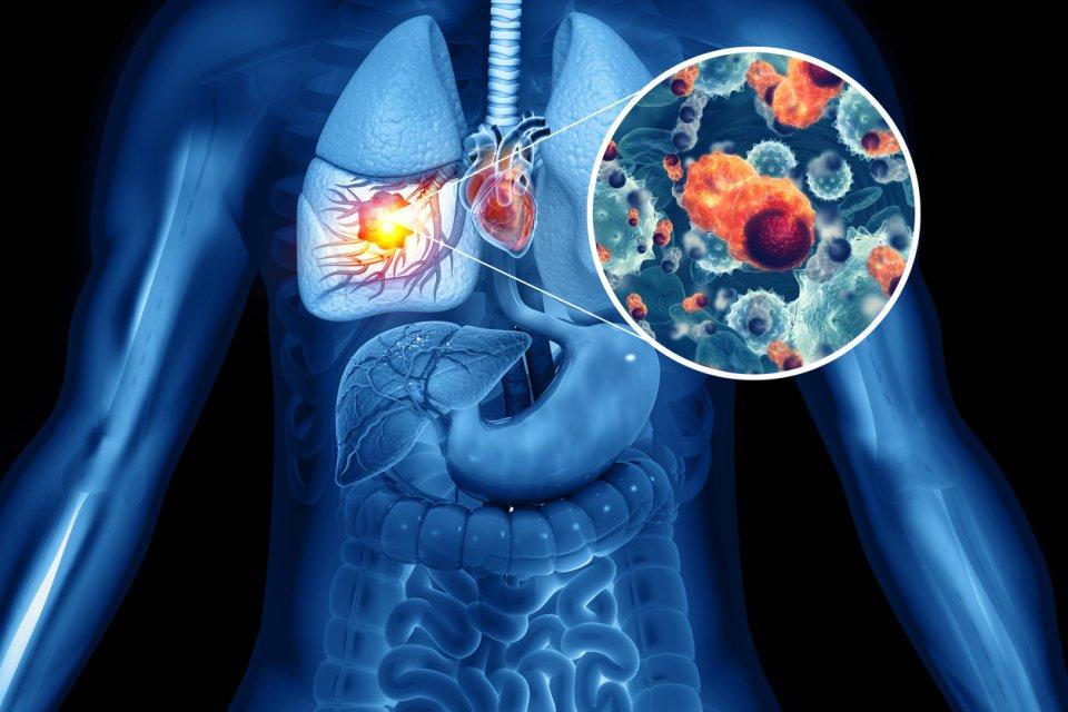 Sugemalimab Receives I, A Recommendation in ESMO Guideline for Consolidation Therapy in Patients with Stage III NSCLC